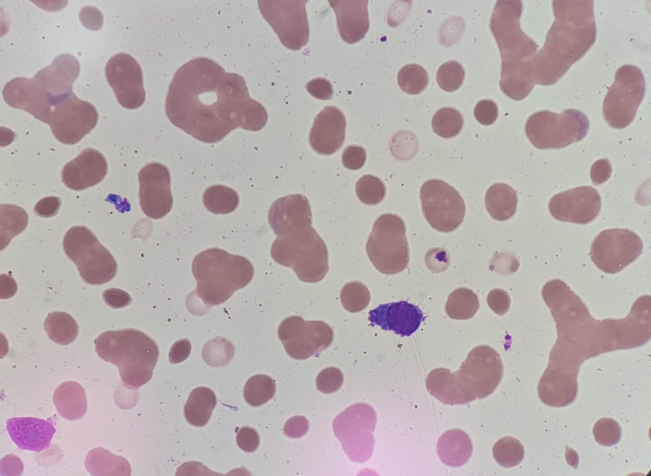Bone marrow cytology showed atypical plasma cells and atypical lymphocytes, compatible with plasma cell myeloma 