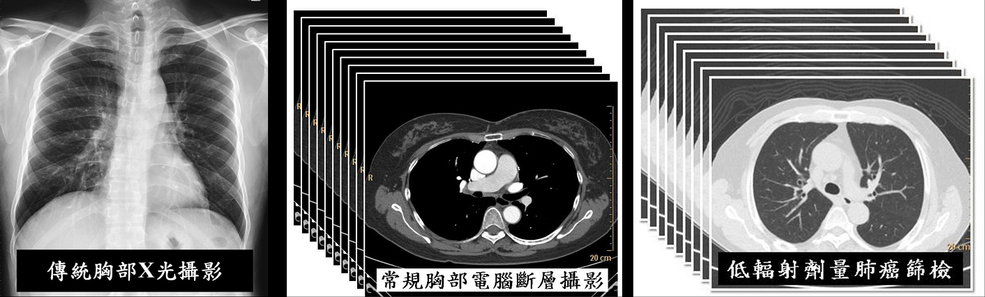 低劑量肺部掃描示意圖