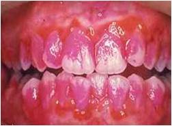 牙菌斑經過染色後所呈現的情況