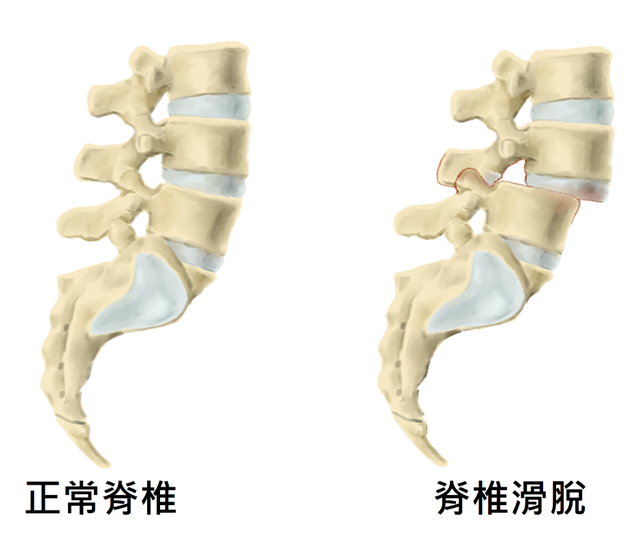 脊椎滑脫-1