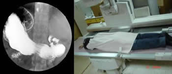 上胃腸道攝影檢查介紹