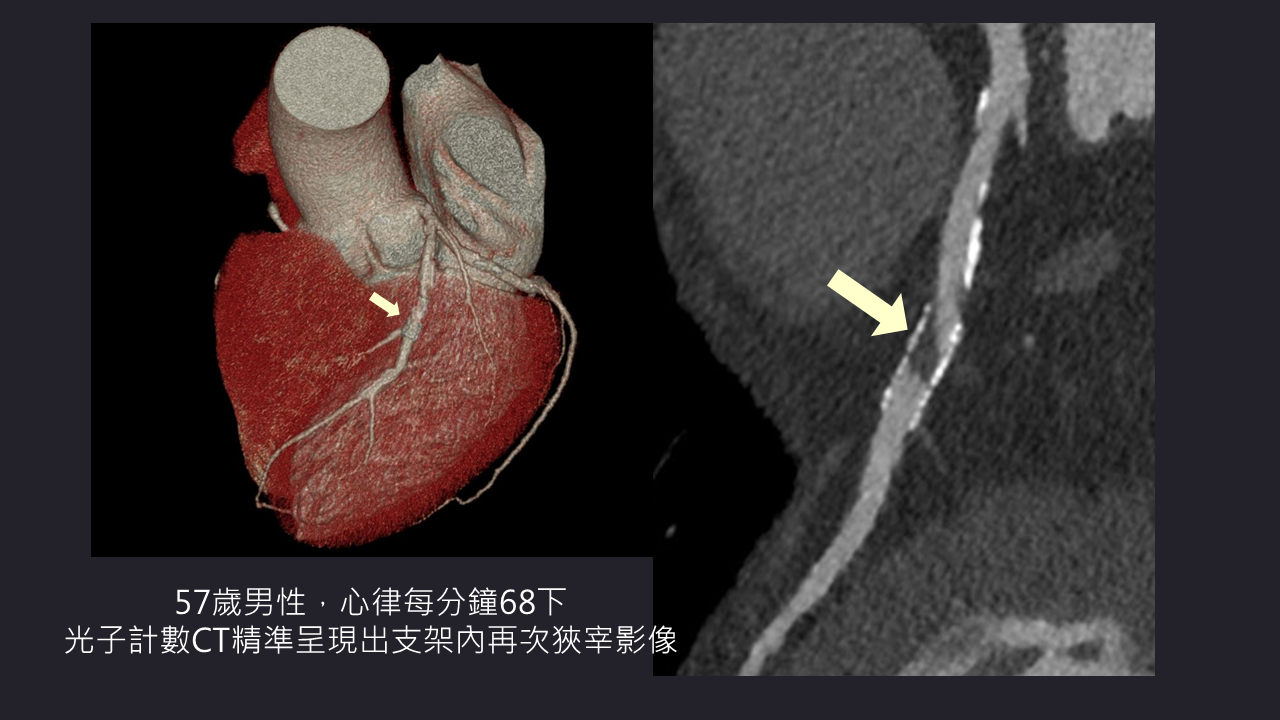 PCCT2