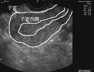 超音波影像圖解(子宮)