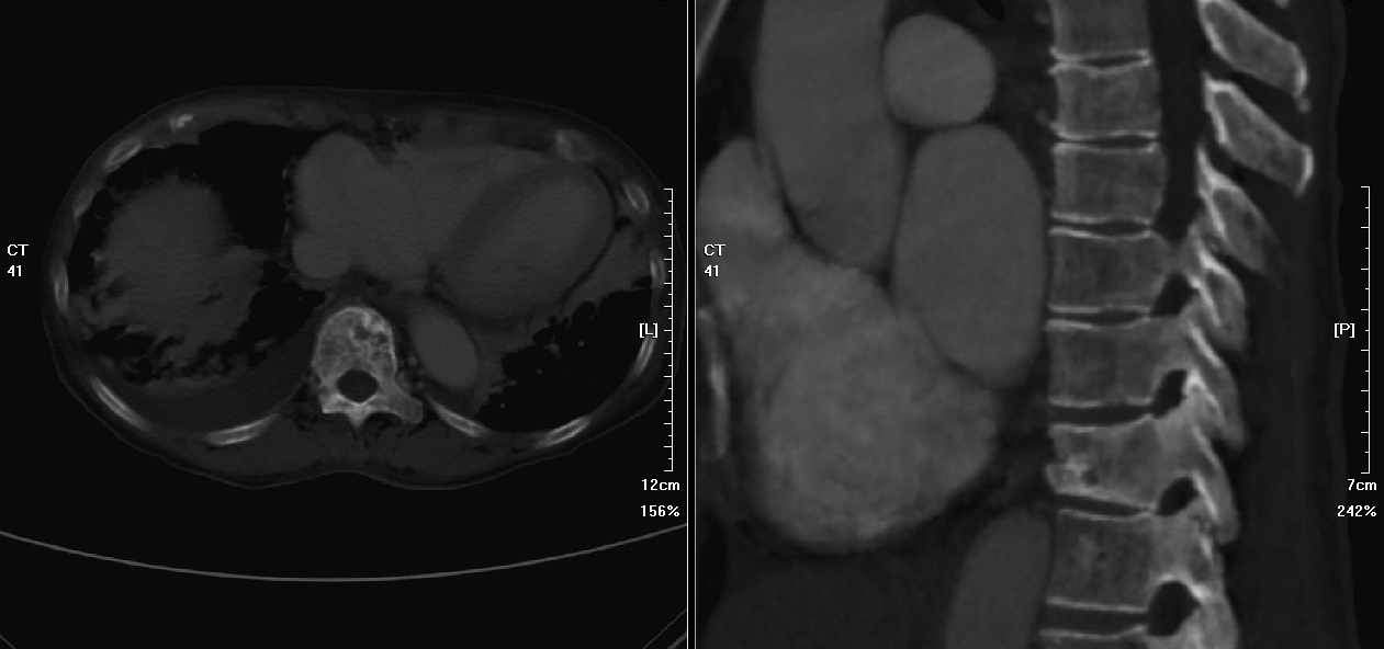 Metastatic bone lesion in T11 vertebral body (Picuture2)