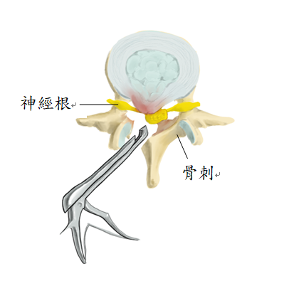 脊椎減壓手術