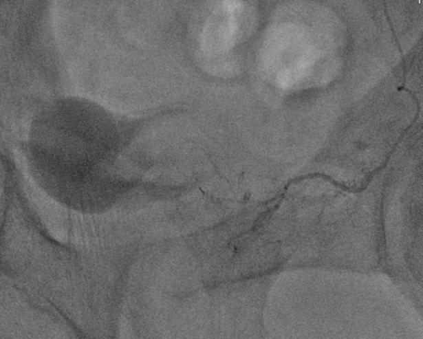 治療過程示意圖