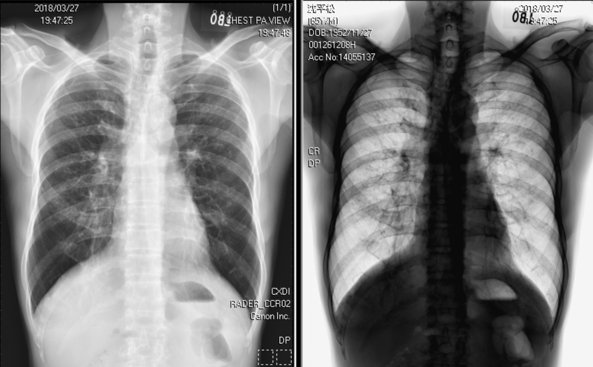 Figure 1. CXR image at OPD: 