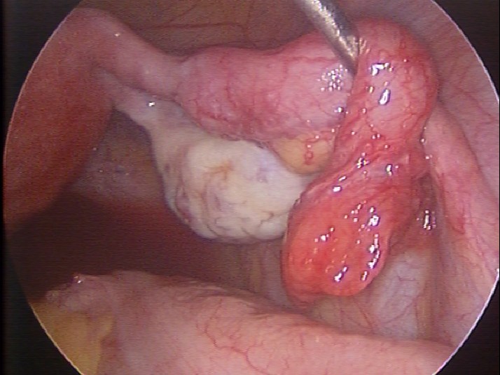 腹腔鏡顯示之影像(輸卵管.卵巢外觀)示意圖