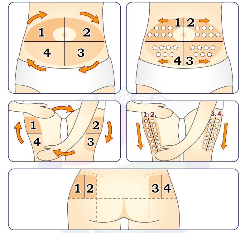 腹部、大腿、臀部注射部位輪替方式示意圖