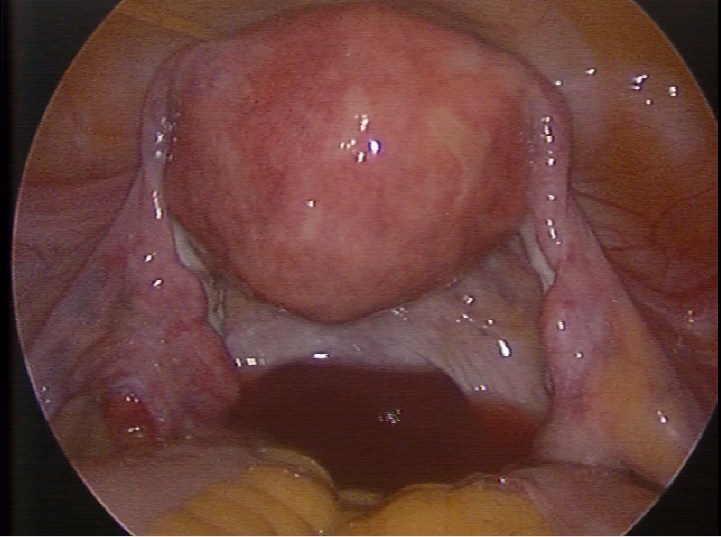 腹腔鏡顯示之影像(子宮.輸卵管外觀)示意圖