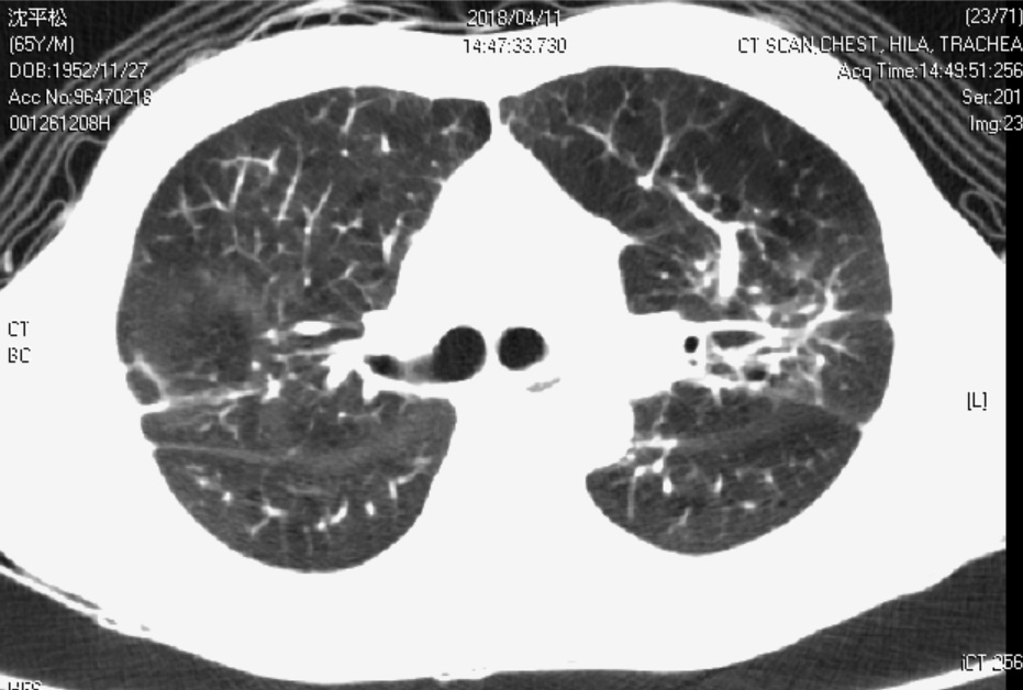 Figure 2. Chest CT image