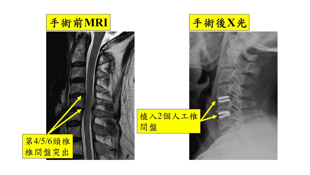 頸前手術-3