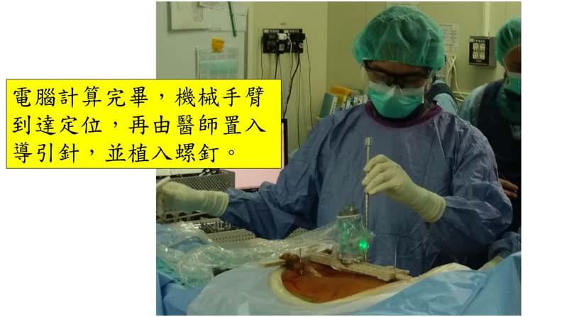 雷納生機械手臂導航手術-2