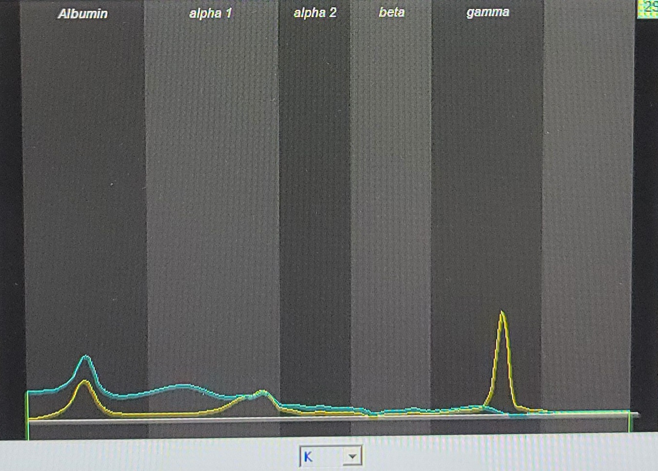 Urine IFE showed IgG/Kappa monoclonal band