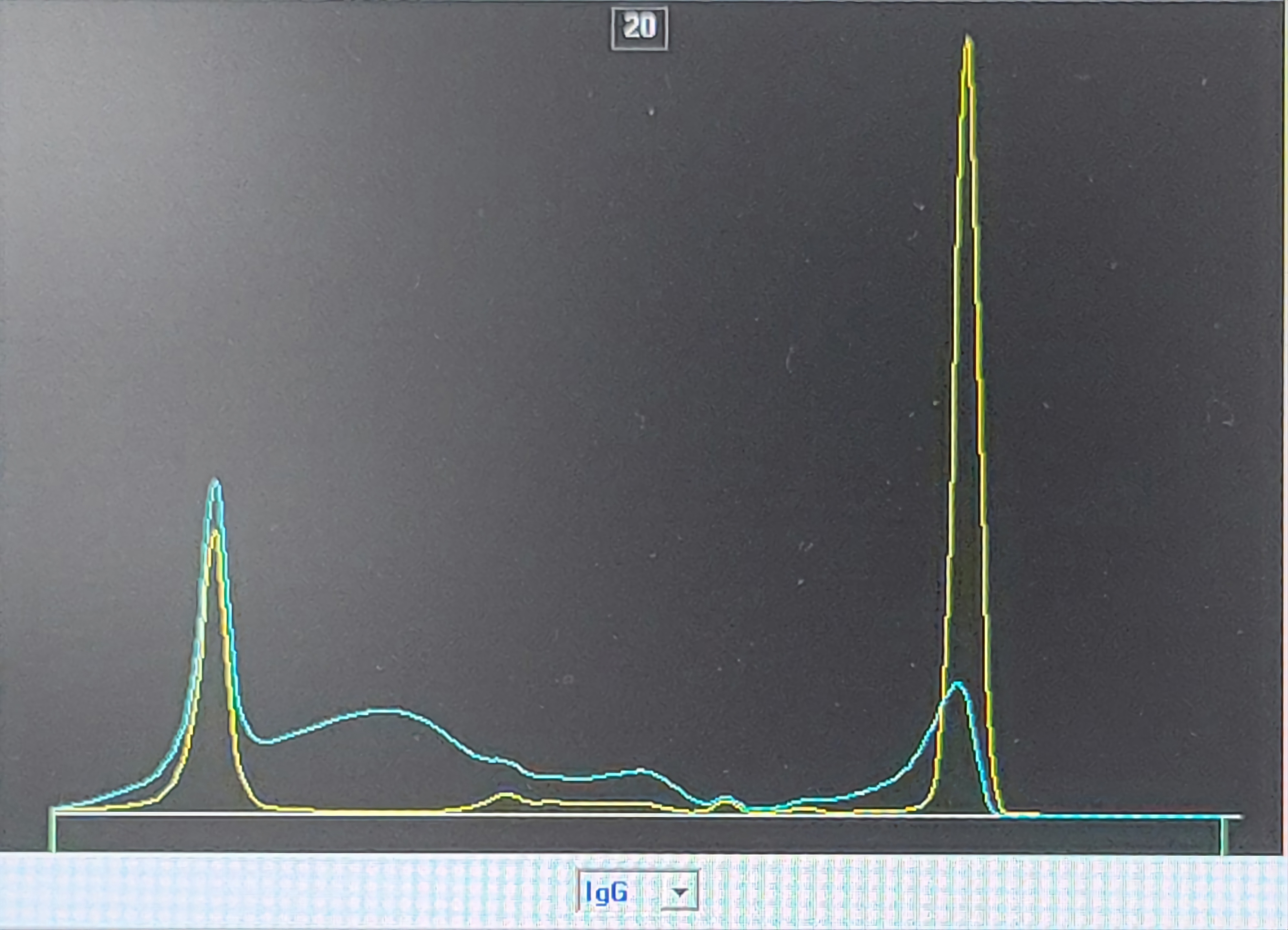 Serum IFE showed IgG/Kappa monoclonal band(Picture 4).