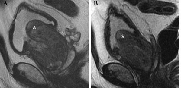 治療前後體積變化