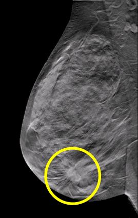 三維(3D)在乳房斷層的切面中發現結構異常