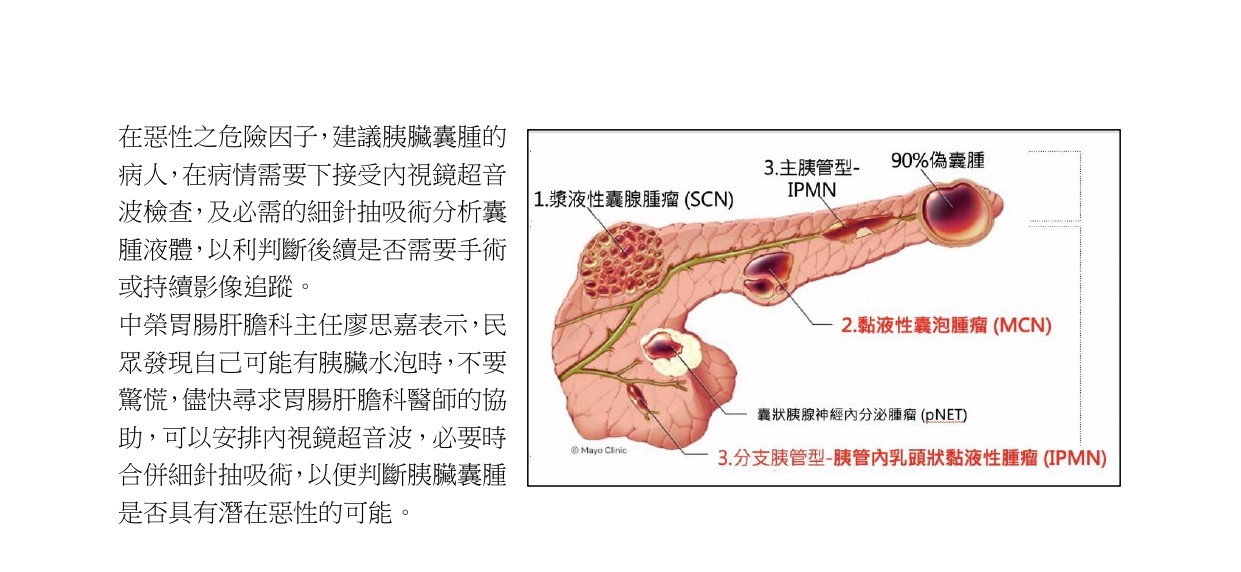 胰臟水泡是不是癌　內視鏡超音波幫忙精準判斷