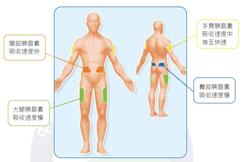 胰島素注射部位示意圖