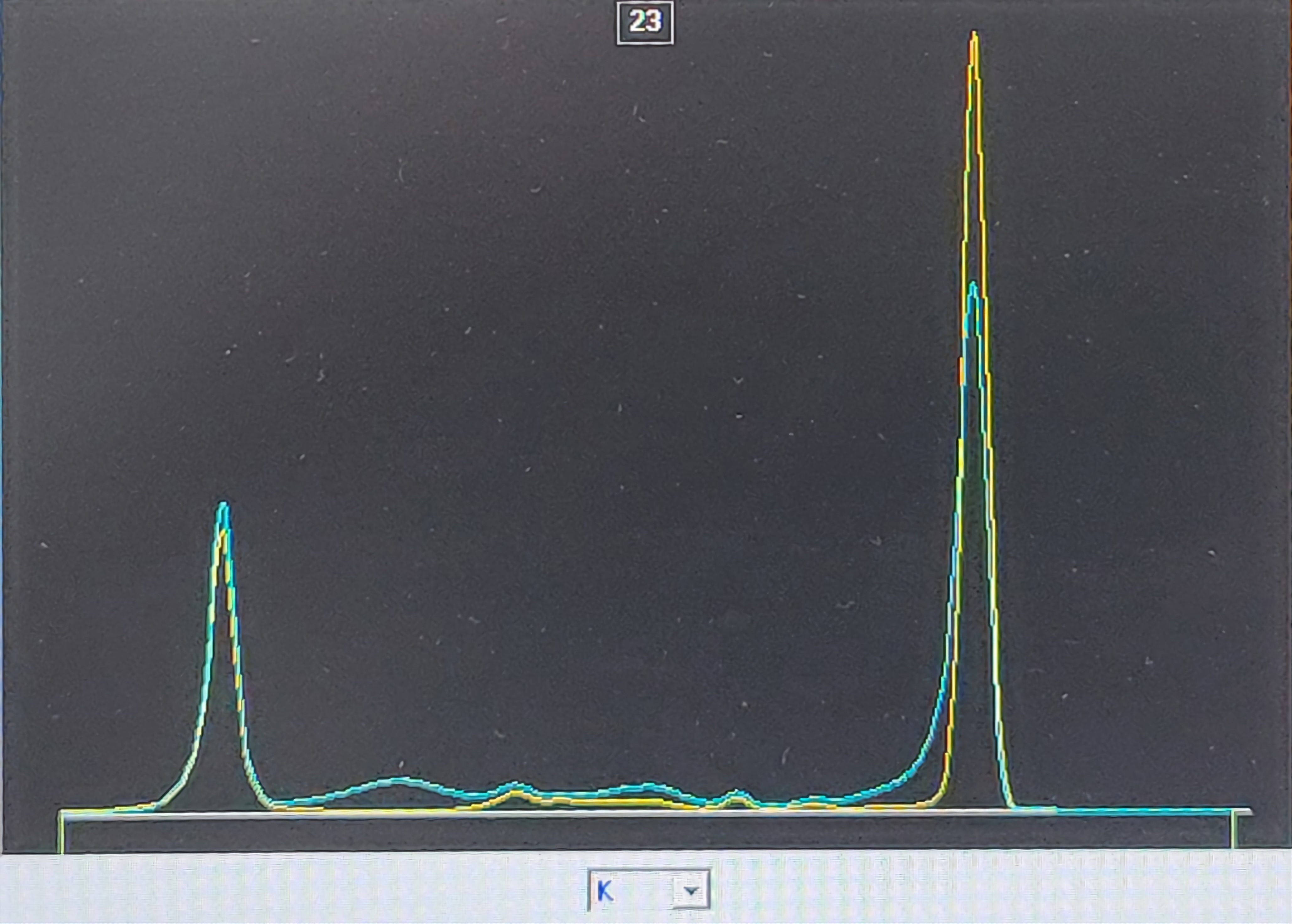 Serum IFE showed IgG/Kappa monoclonal band(Picture 4).