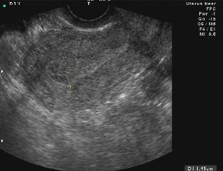 超音波顯示之影像(子宮)