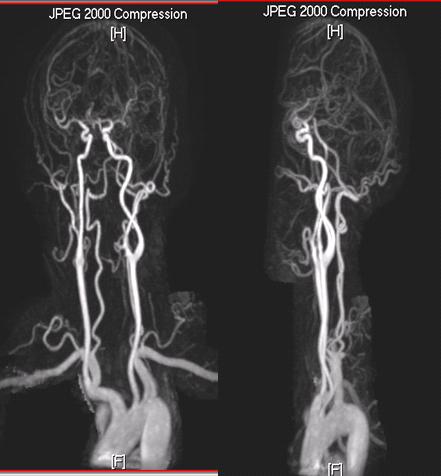 高解析度的頭頸神經血管磁振造影檢查示意圖