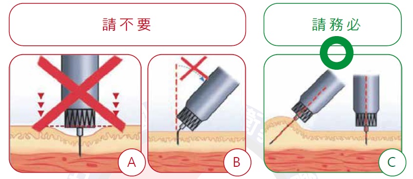 注射角度示意圖