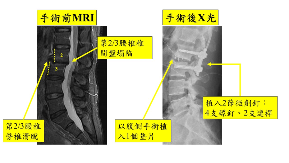 脊椎融合手術-2