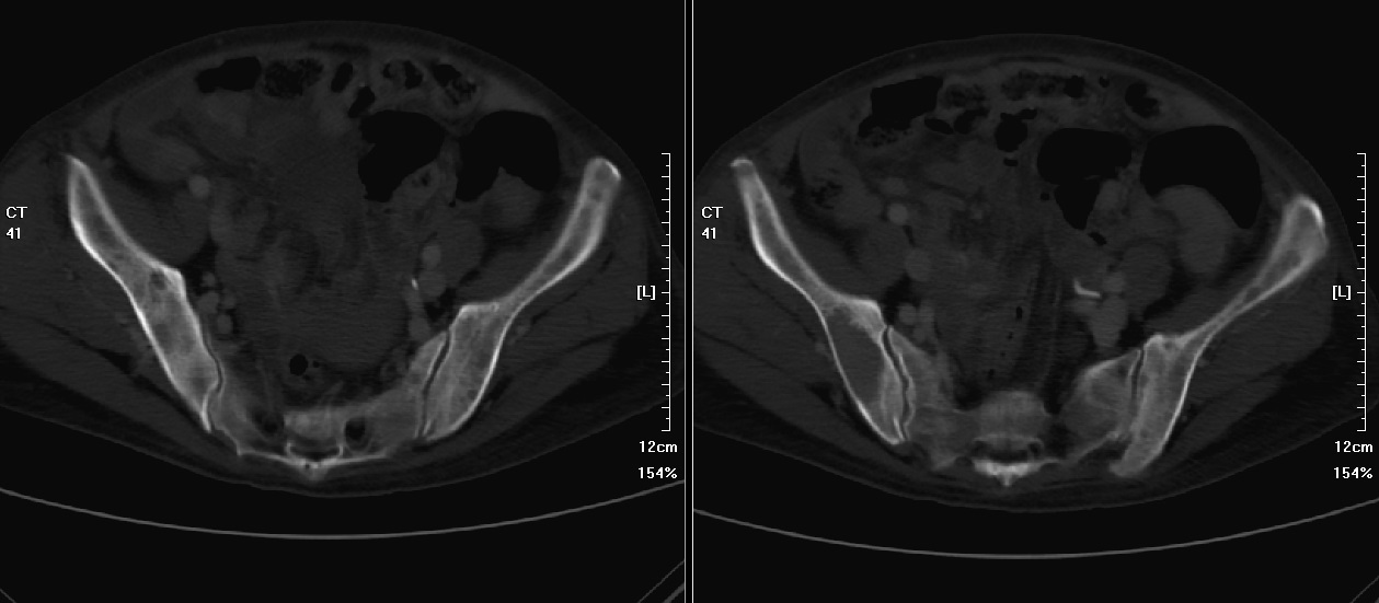 Metastatic bone lesions in pelvic bone(Picture 1)