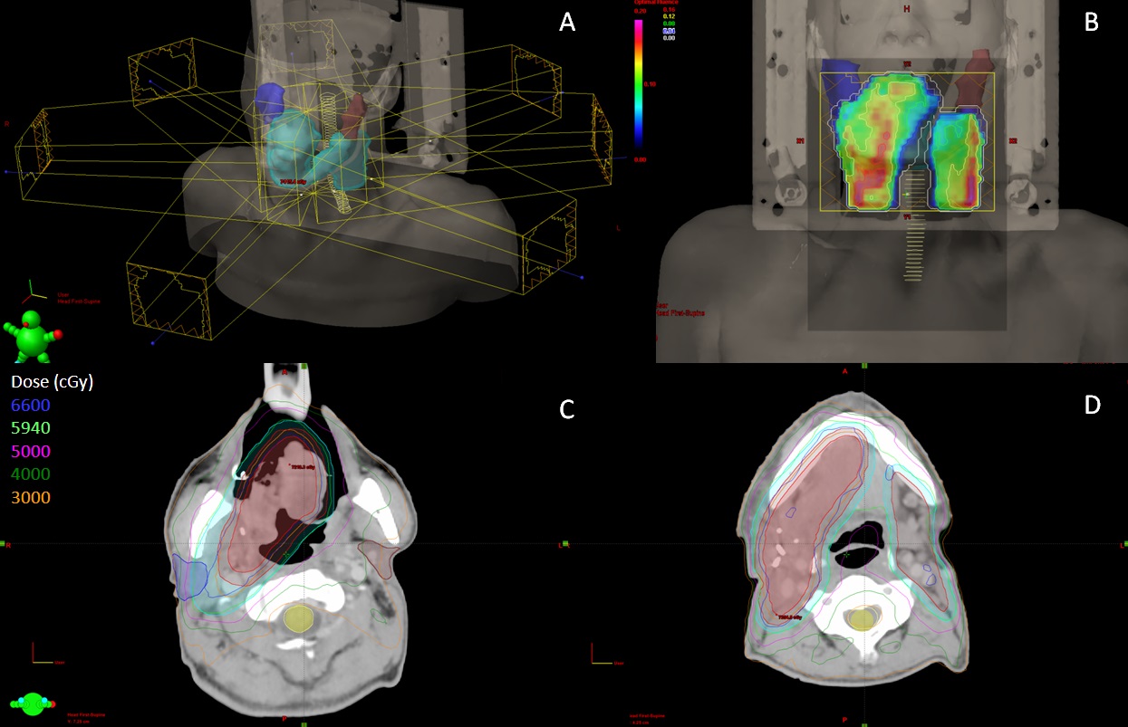 強度調控放射治療（IMRT）