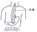 結腸移植重建術