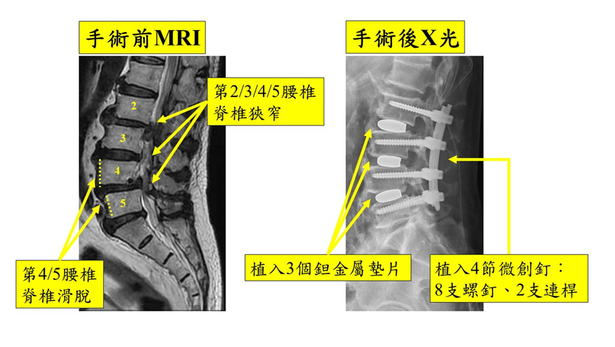 脊椎融合手術-1