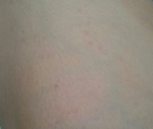 Skin rash