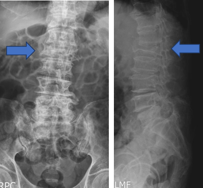 壓迫性骨折 X光