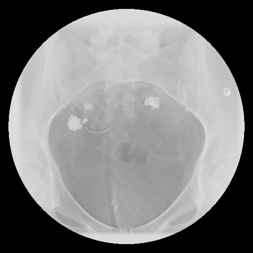 顯影劑滯留於雙側輸卵管周圍-骨盆腔沾黏示意圖