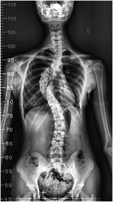 脊椎側彎-1