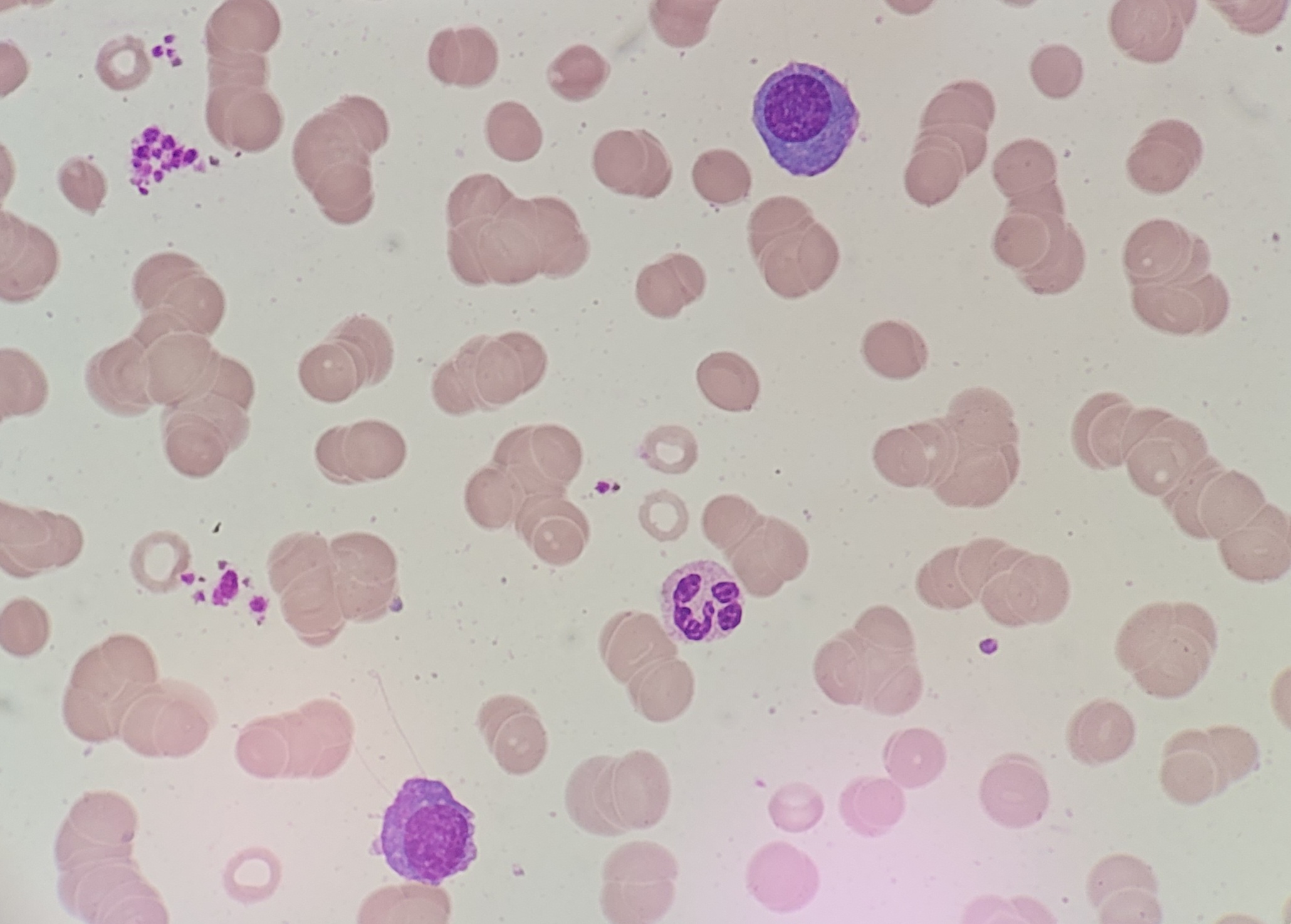 Bone marrow cytology showed atypical plasma cells and atypical lymphocytes, compatible with plasma cell myeloma 