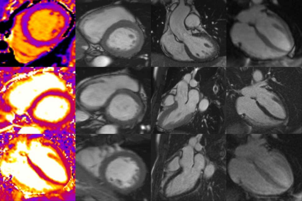 mri_heart