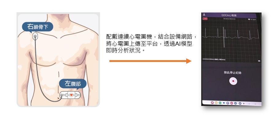 配戴連續心電圖機，結合設備網路，將心電圖上傳至平台，透過AI模型即時分析狀況。