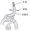 結腸段移植重建術