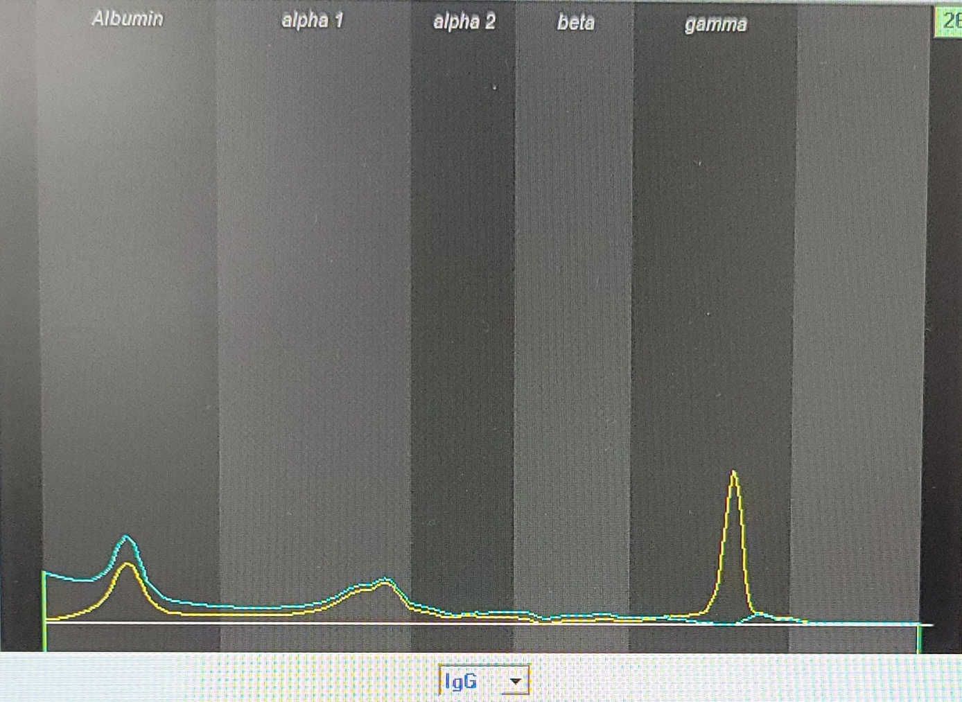 Urine IFE showed IgG/Kappa monoclonal band