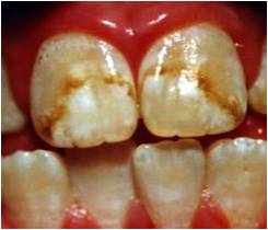 牙齒漂白治療
