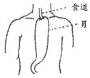 胃移植重建術